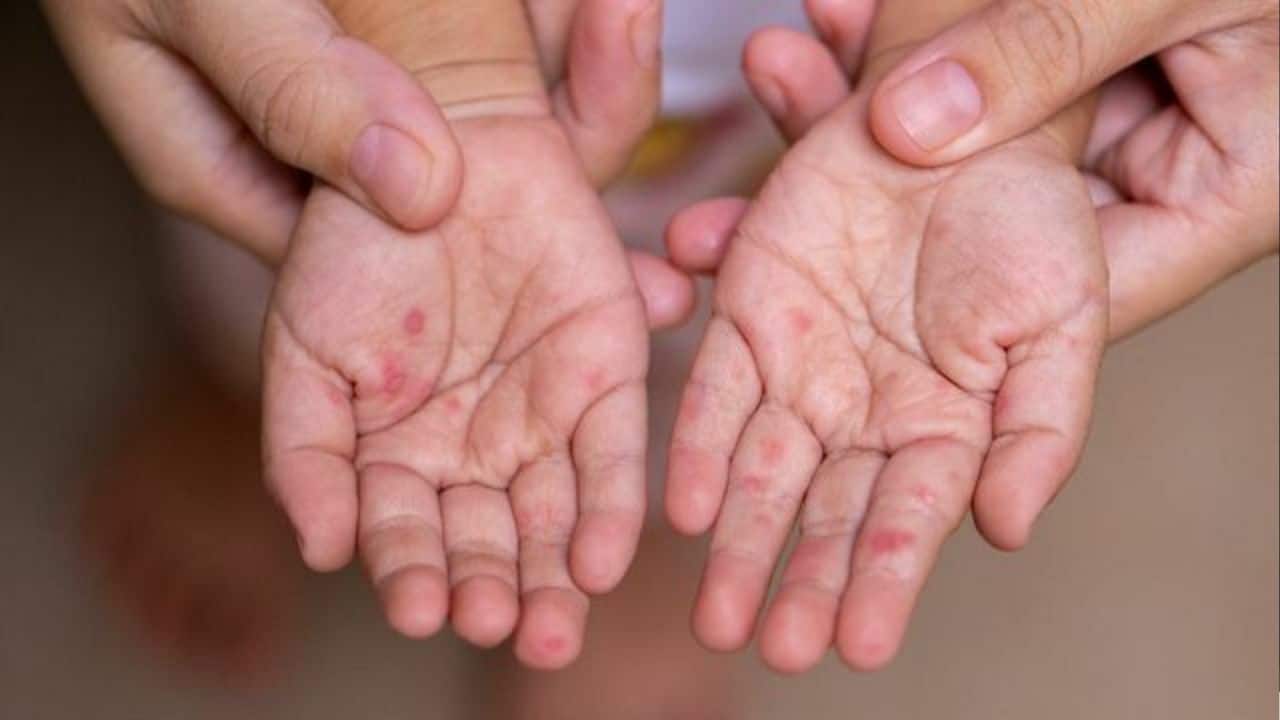 Вспышка болезни рук, ног и рта поражает маленьких детей